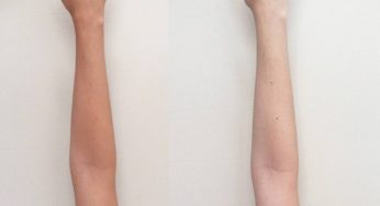 How To Remove Sun Tan Naturally